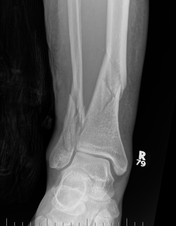 Distal Tibial Fracture